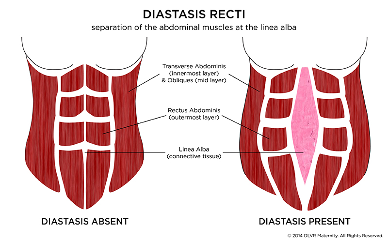 Episode 3: Diastasis Recti & Postpartum Depression